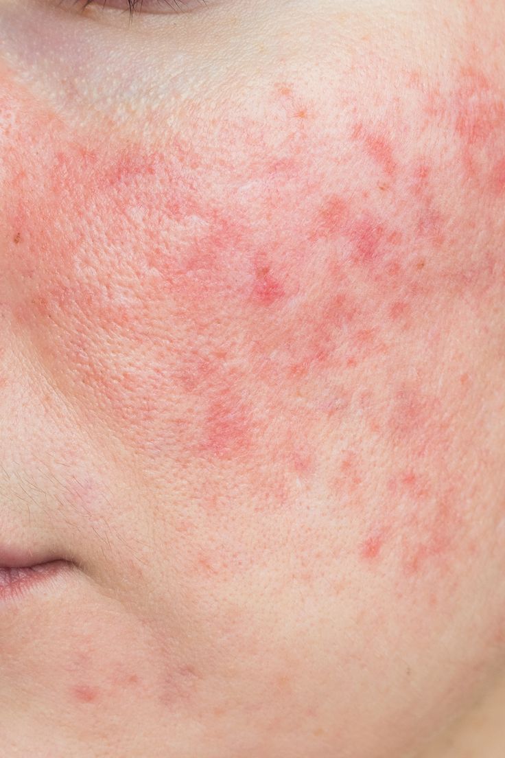Sensitive-Skin